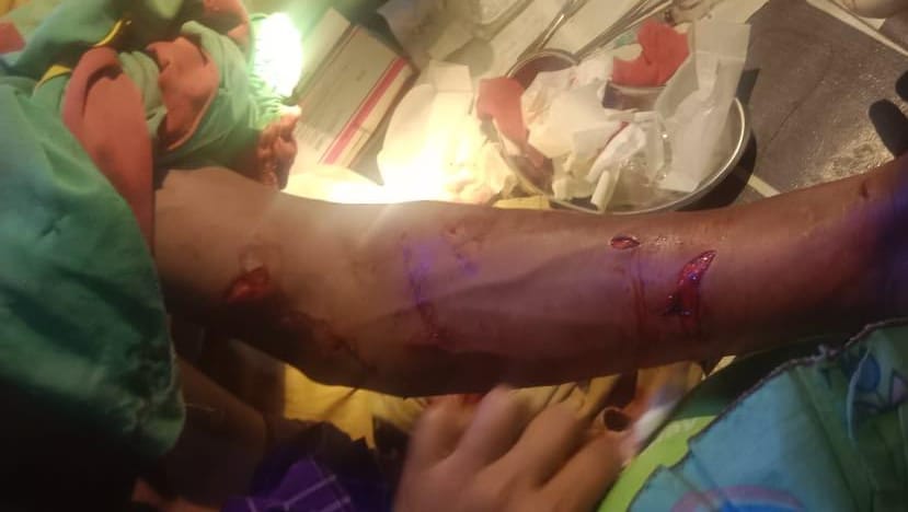 Lengan Korban terluka robek usai diterkam buaya. (Foto: Polsek Pamukan Selatan/Koranbanjar.net)