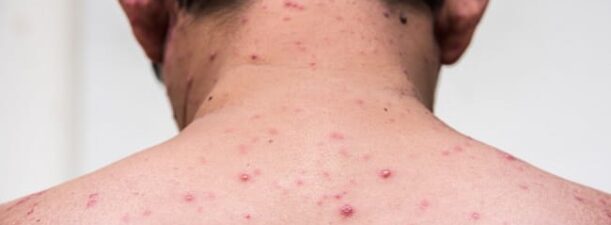 RSD Idaman Banjarbaru Ingatkan Bahaya Virus Penyakit Cacar Monyet